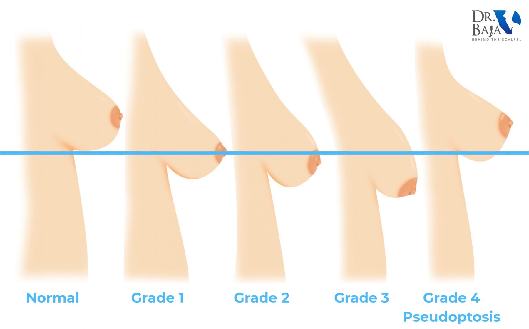 Grades mastopexy